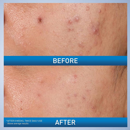 CeraVe Salicylic Acid Acne Treatment with Glycolic Acid and Lactic Acid - ZM Cosmetics