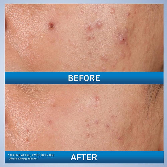 CeraVe Salicylic Acid Acne Treatment with Glycolic Acid and Lactic Acid - ZM Cosmetics